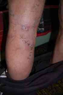 Die Wunden die der Bär geschlagen hatte gingen tief ins Fleisch und heilen nur langsam. Foto: BR | Stephan Ozsváth