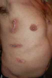 Die Wunden die der Bär geschlagen hatte gingen tief ins Fleisch und heilen nur langsam. Foto: BR | Stephan Ozsváth