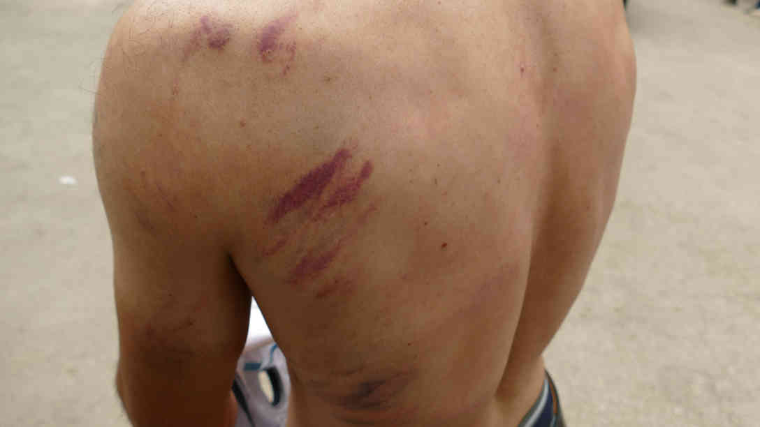 Flüchtling im bosnischen Bihac zeigt seine Verletzungen, die ihm nach eigenen Angaben kroatische Grenzpolizisten zugefügt haben sollen. Foto: BR | Eldina Jasarevic