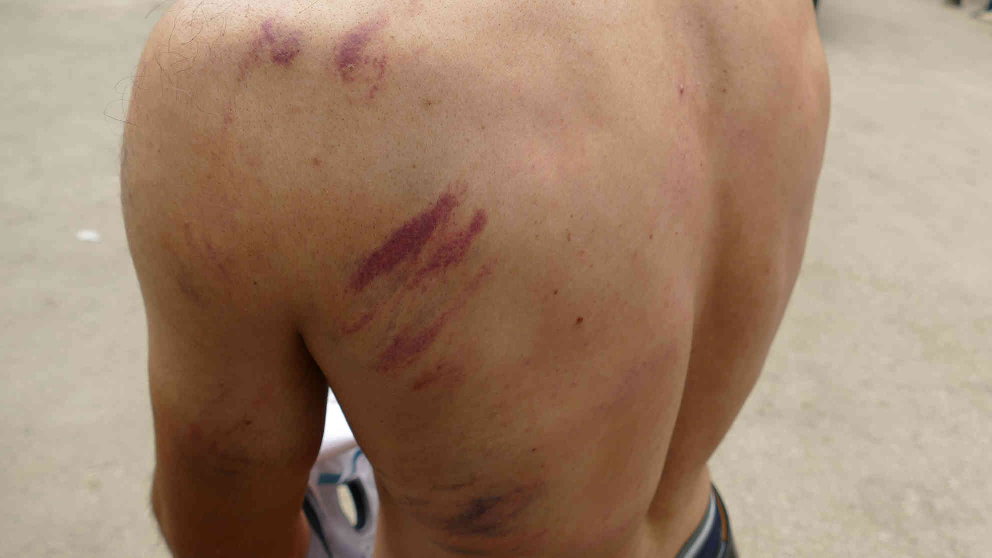 Flüchtling im bosnischen Bihac zeigt seine Verletzungen, die ihm nach eigenen Angaben kroatische Grenzpolizisten zugefügt haben sollen. Foto: BR | Eldina Jasarevic