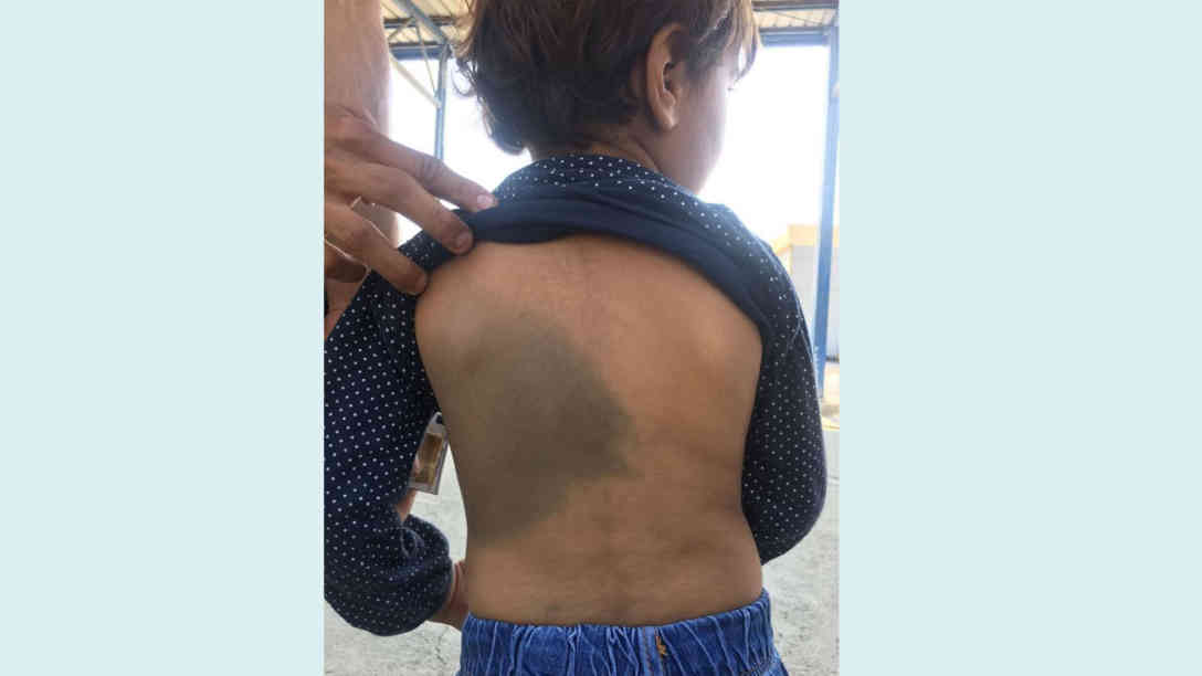 Diese Verletzungen hat die österreichische Nichtregierungsorganisation SOS Balkanroute dokumentiert. Eine Folge kroatischer Grenzgewalt und Pushbacks. Regelmäßig werden auch Kinder Opfer von Grenzgewalt und Pushbacks. Foto: SOS Balkanroute